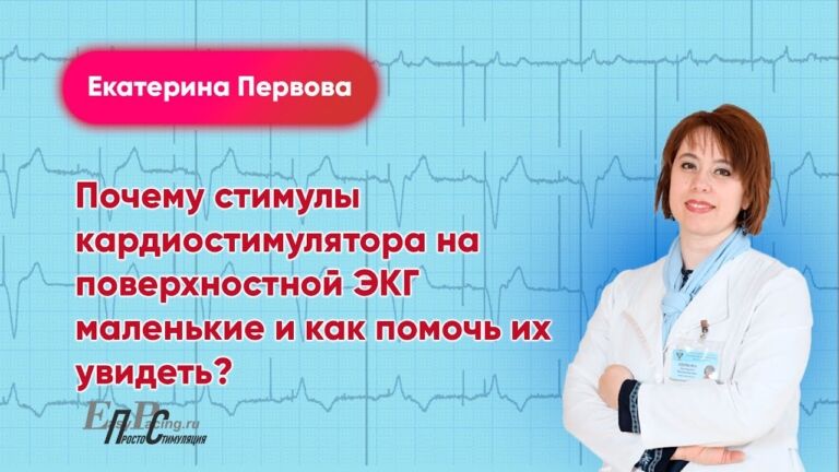 Почему стимулы кардиостимулятора на поверхностной ЭКГ маленькие и как помочь их увидеть?